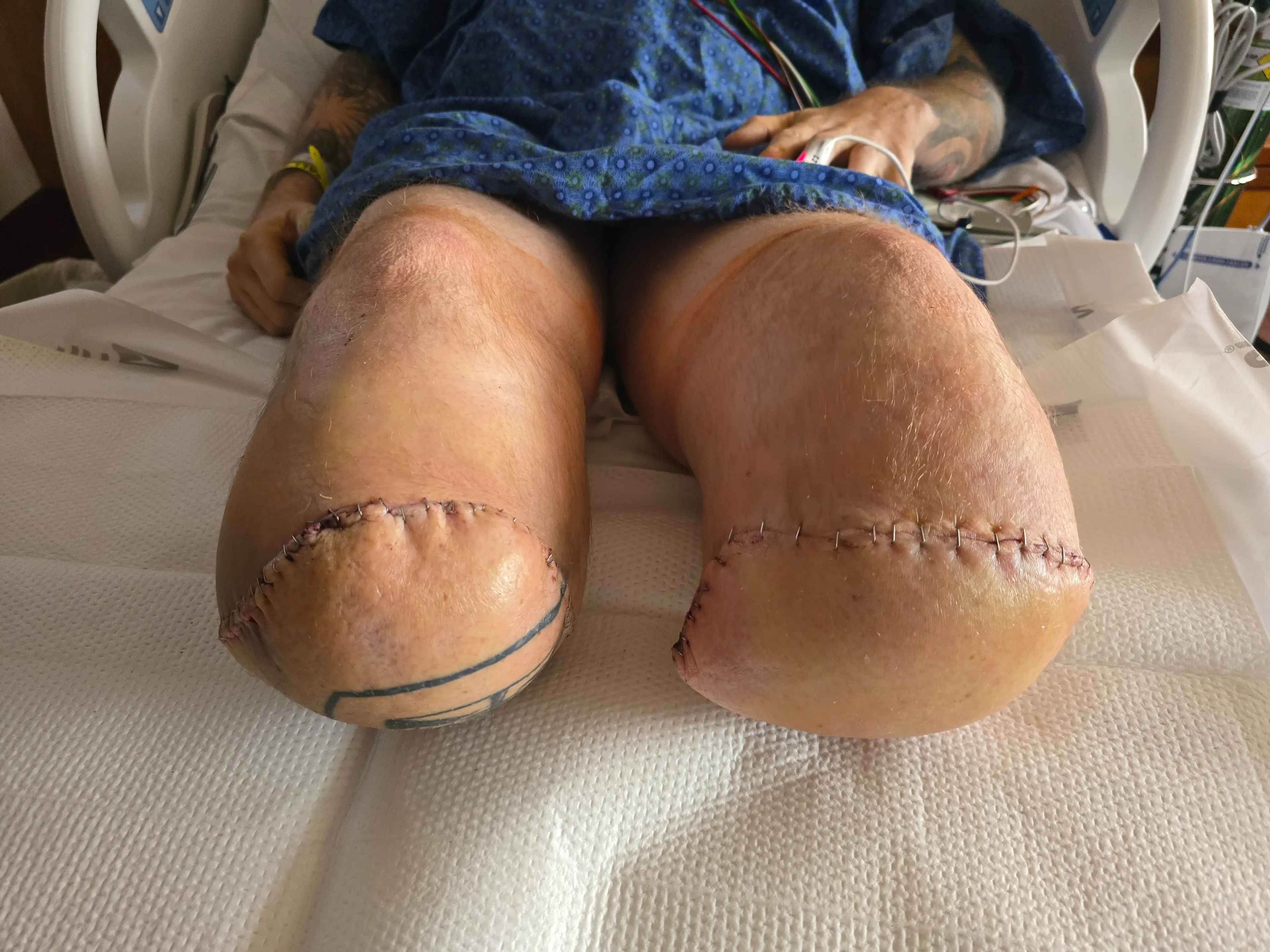 Max's legs after double amputation (SWNS)