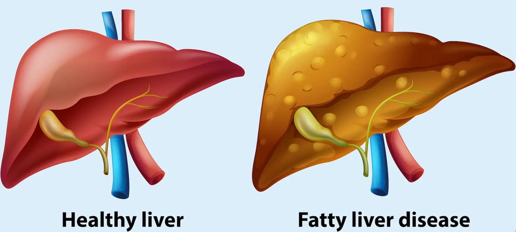 Non-alcoholic fatty liver disease is very common (Getty Stock Images)