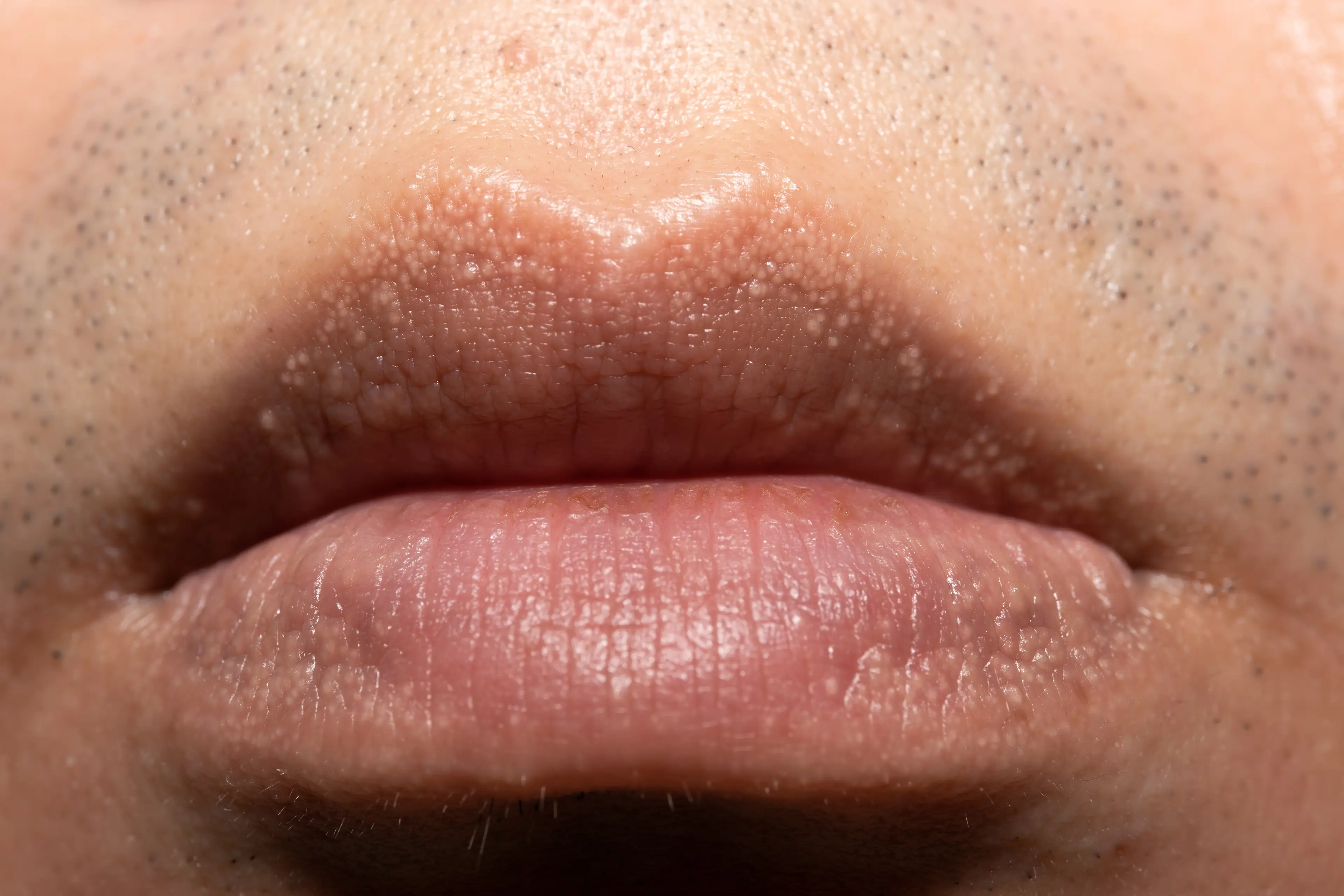 Fordyce spots around the lips, they also occur in other places we won't show you pictures of (Getty Stock Photo)