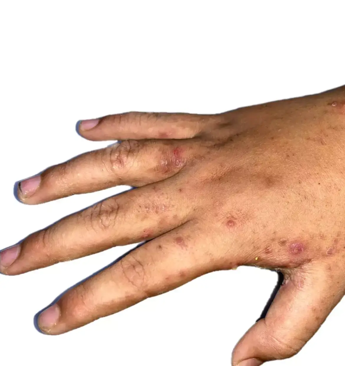 Scabies can spread to any part of the body (Getty Stock Image)