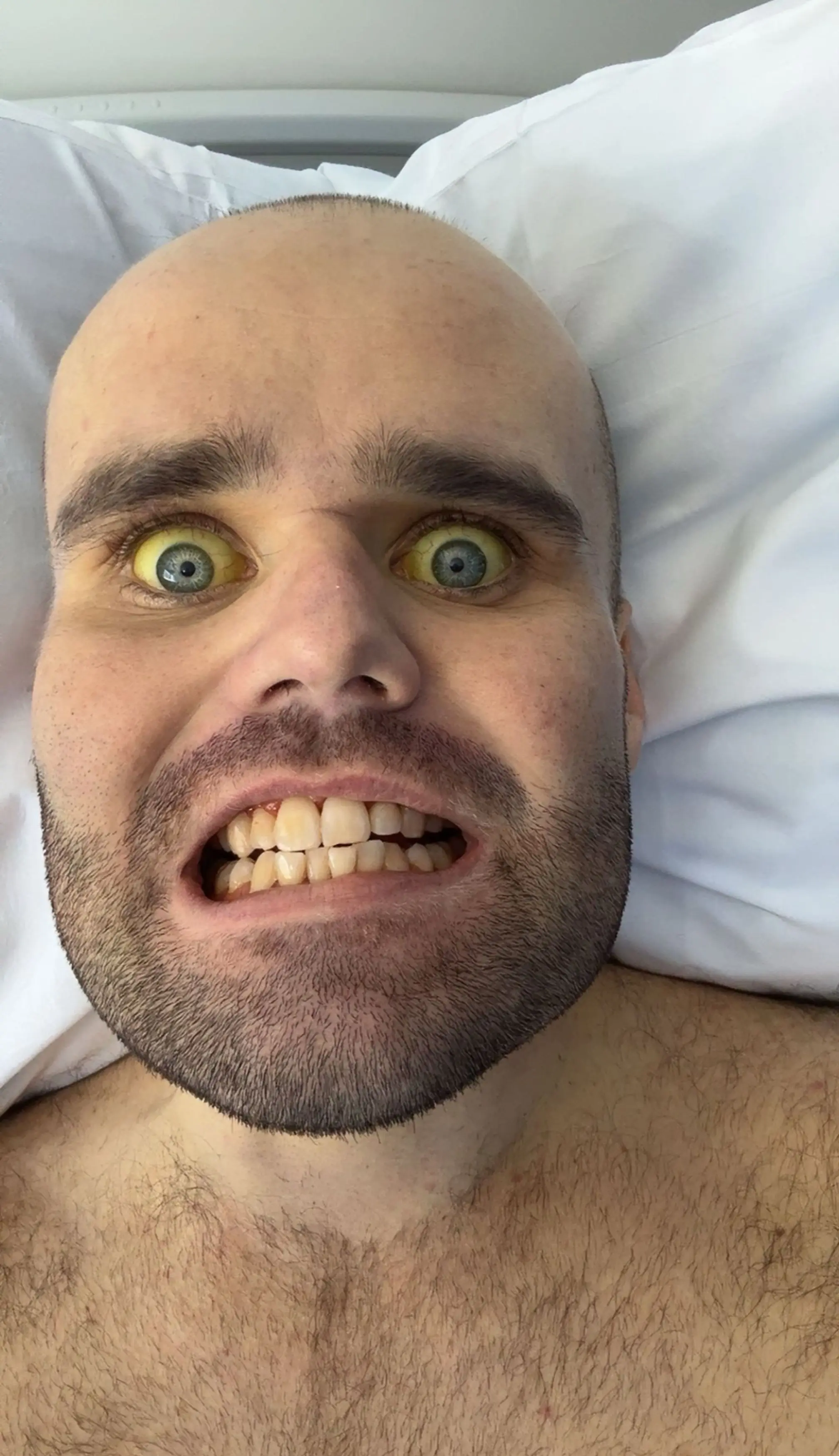 The consequences of his drinking saw his whole body turn yellow (Kennedy News and Media)