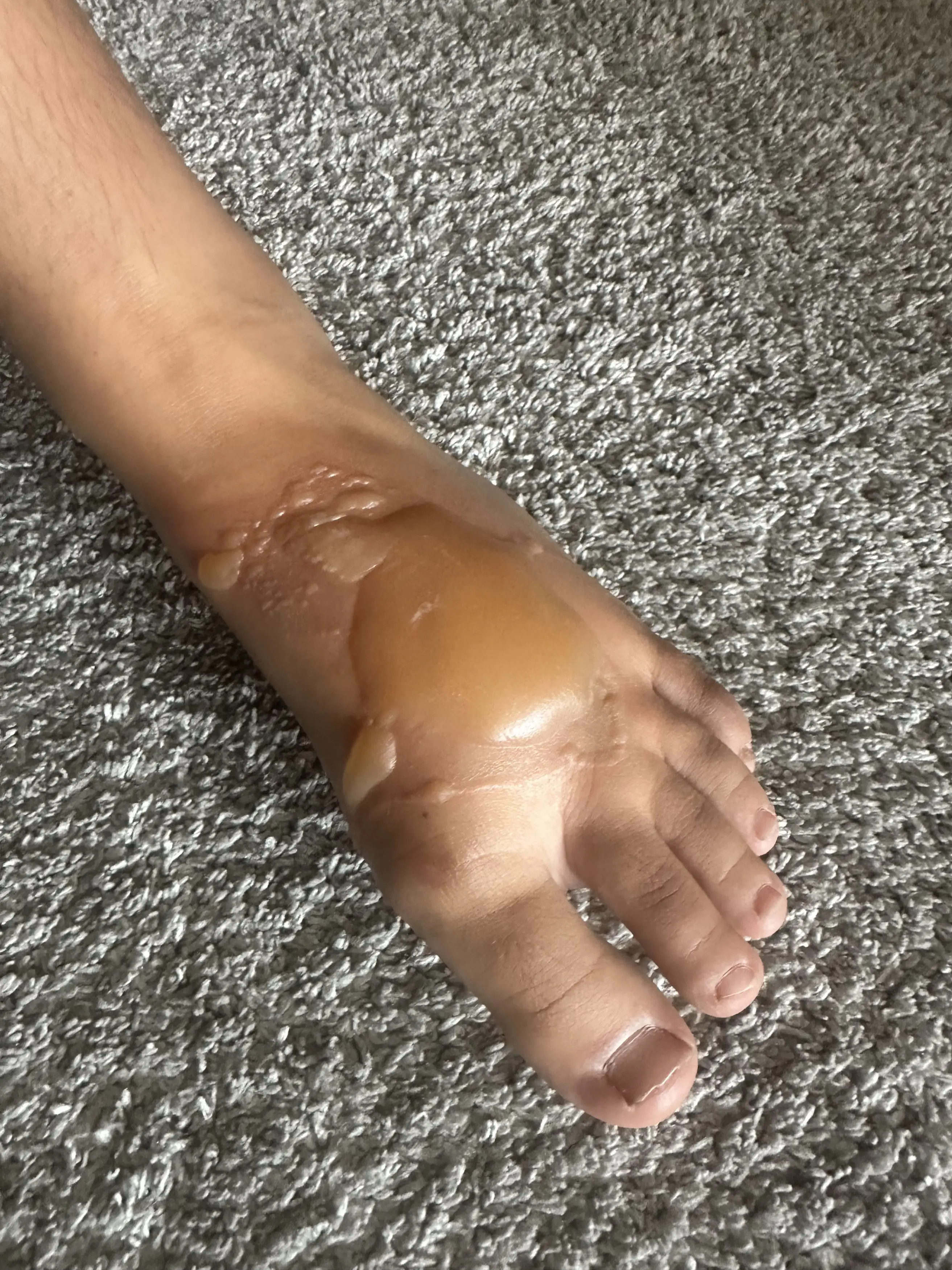 The youngster's foot started to 'bubble' (Kennedy News & Media)