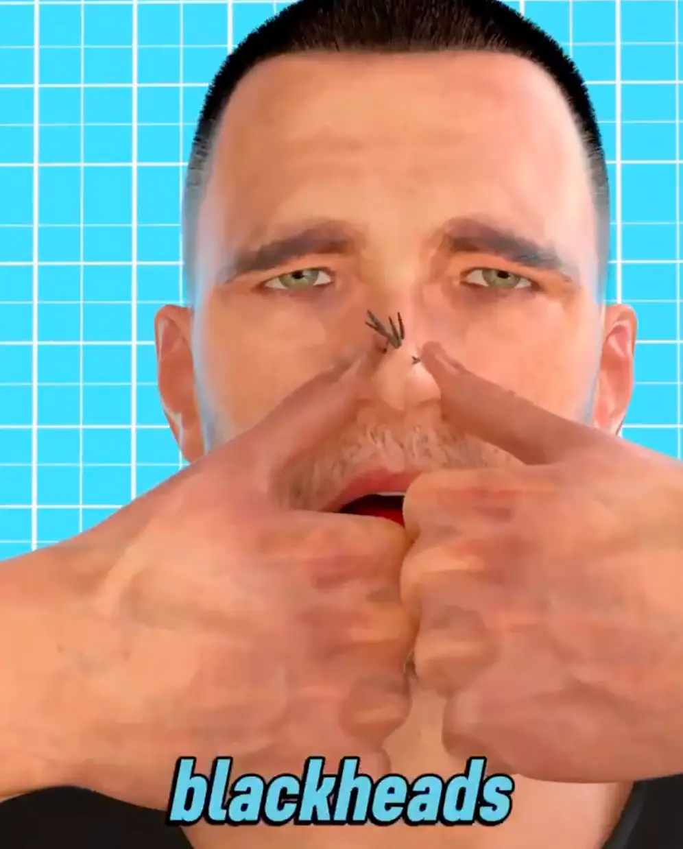 This is not the way you should remove blackheads (TikTok/mind_myst)