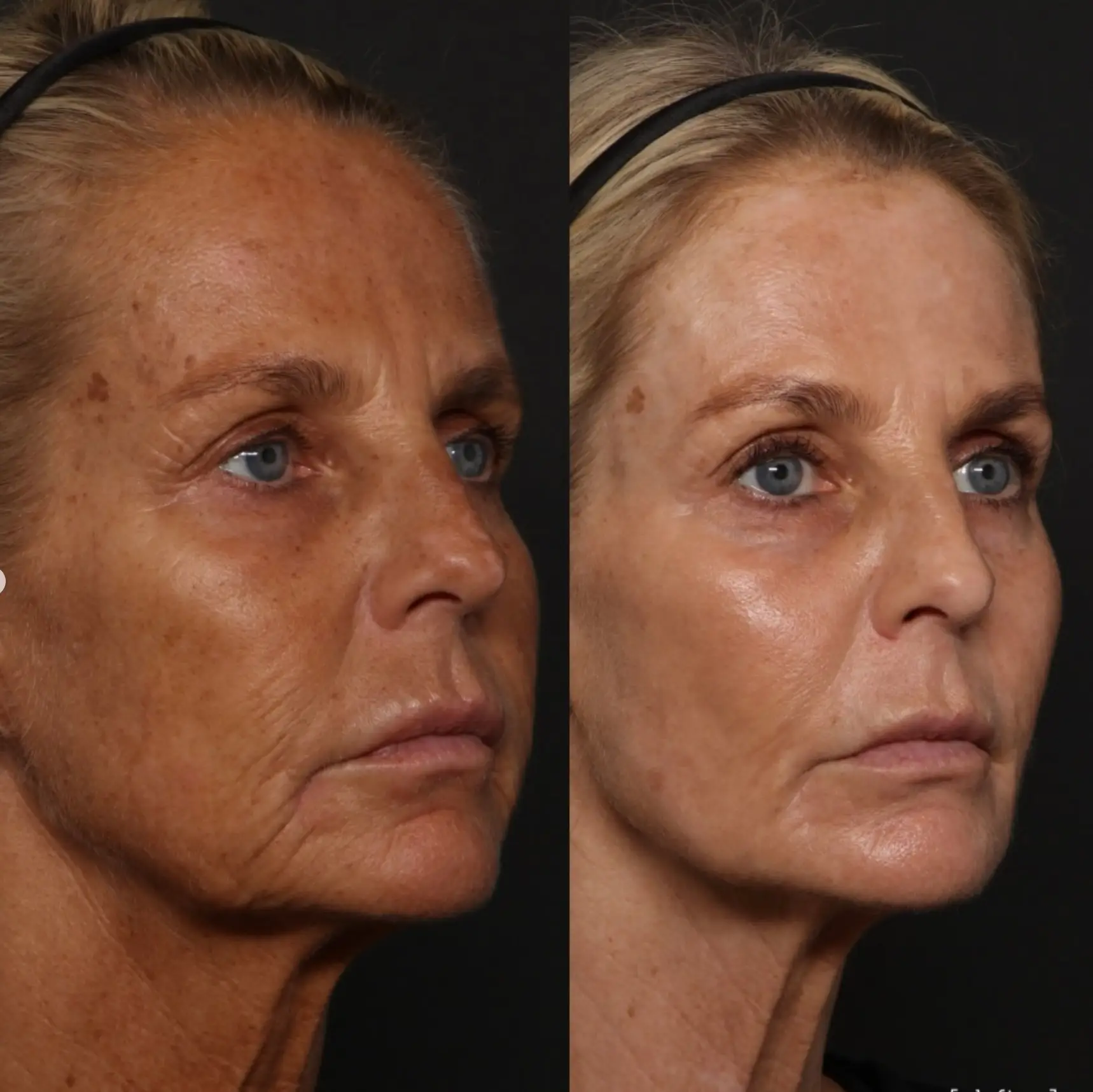 Jonsson, 58, said she began trying to transform her skin six months ago (Instagram/@defineclinic)
