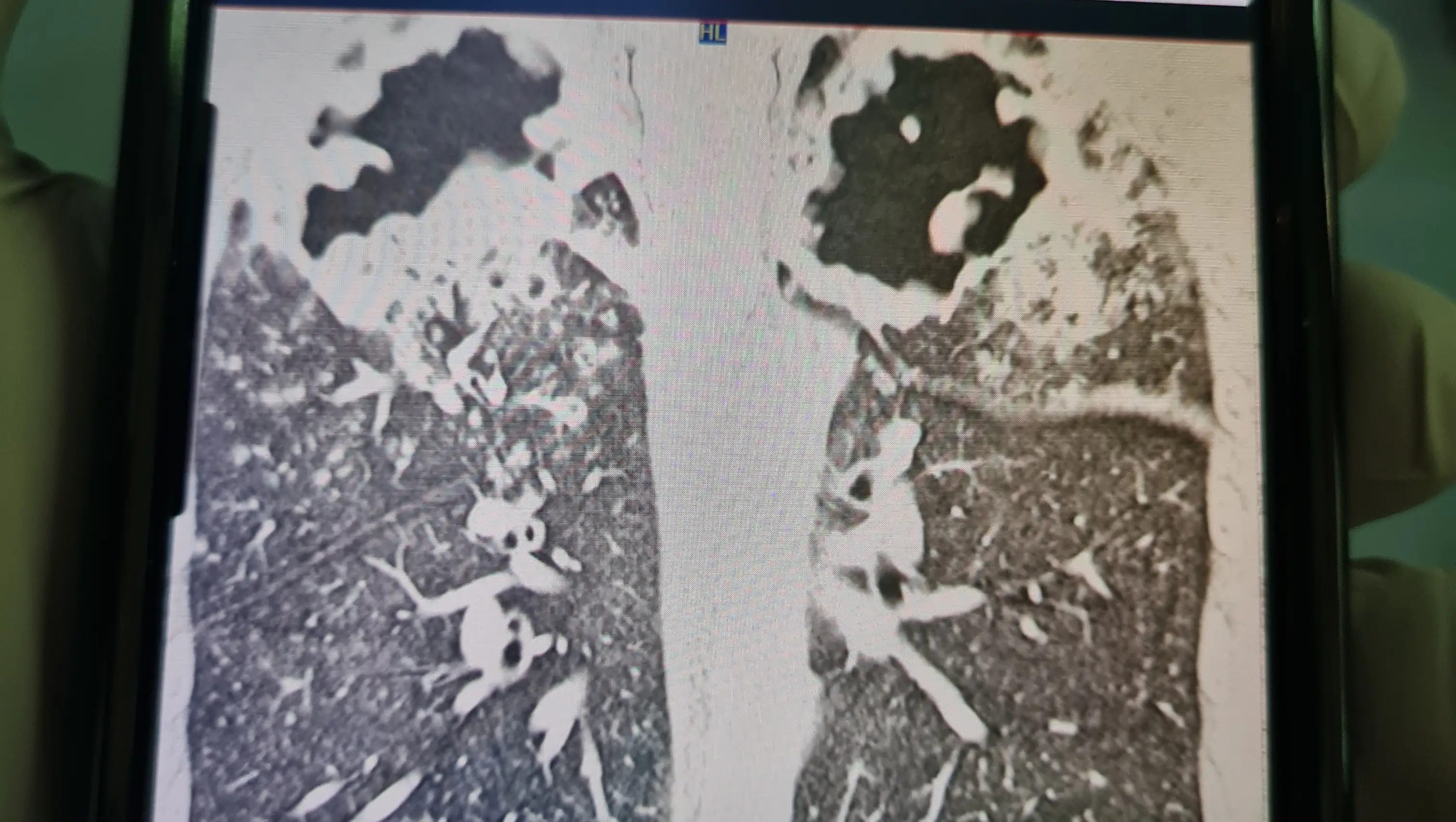 Chris Capper has a 'likely incurable' infection (GoFundMe)