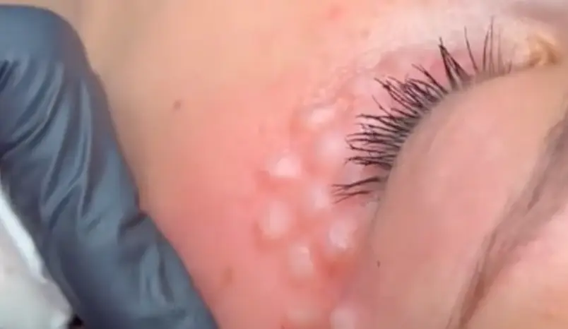 Photos and clips of the procedure have attracted attention on social media (Instagram)