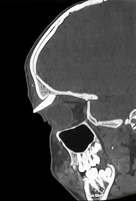 An x-ray of the teenager's head found a canine tooth growing in his eye socket (AAO Journal)