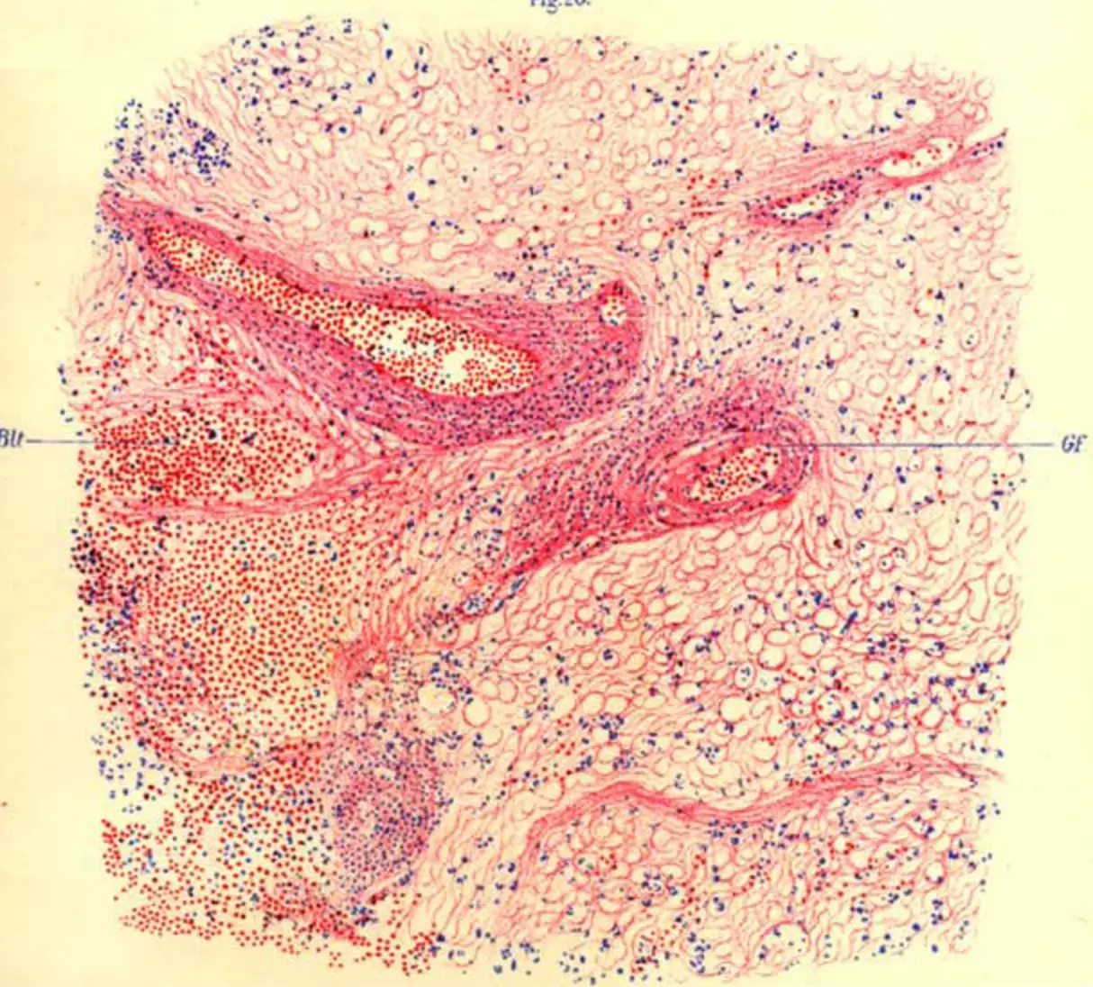 There have only been 80 registered cases of encephalitis lethargica in the last 85 years. (Franz Deuticke, ss. 1-79. Leipzig-Wien 1918/Public Domain/Wikimedia commons)