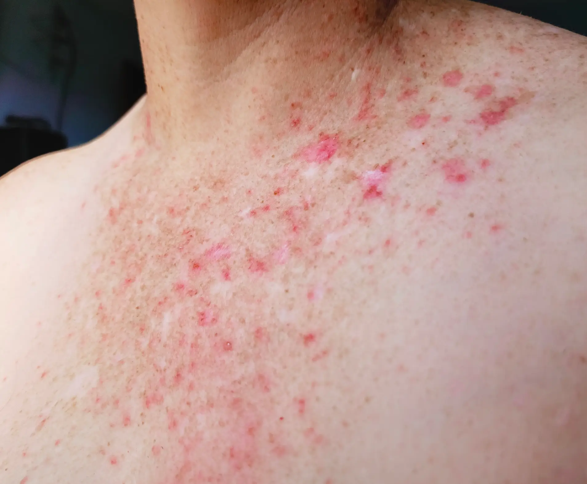 A rash could be a sign (Getty Stock Image)