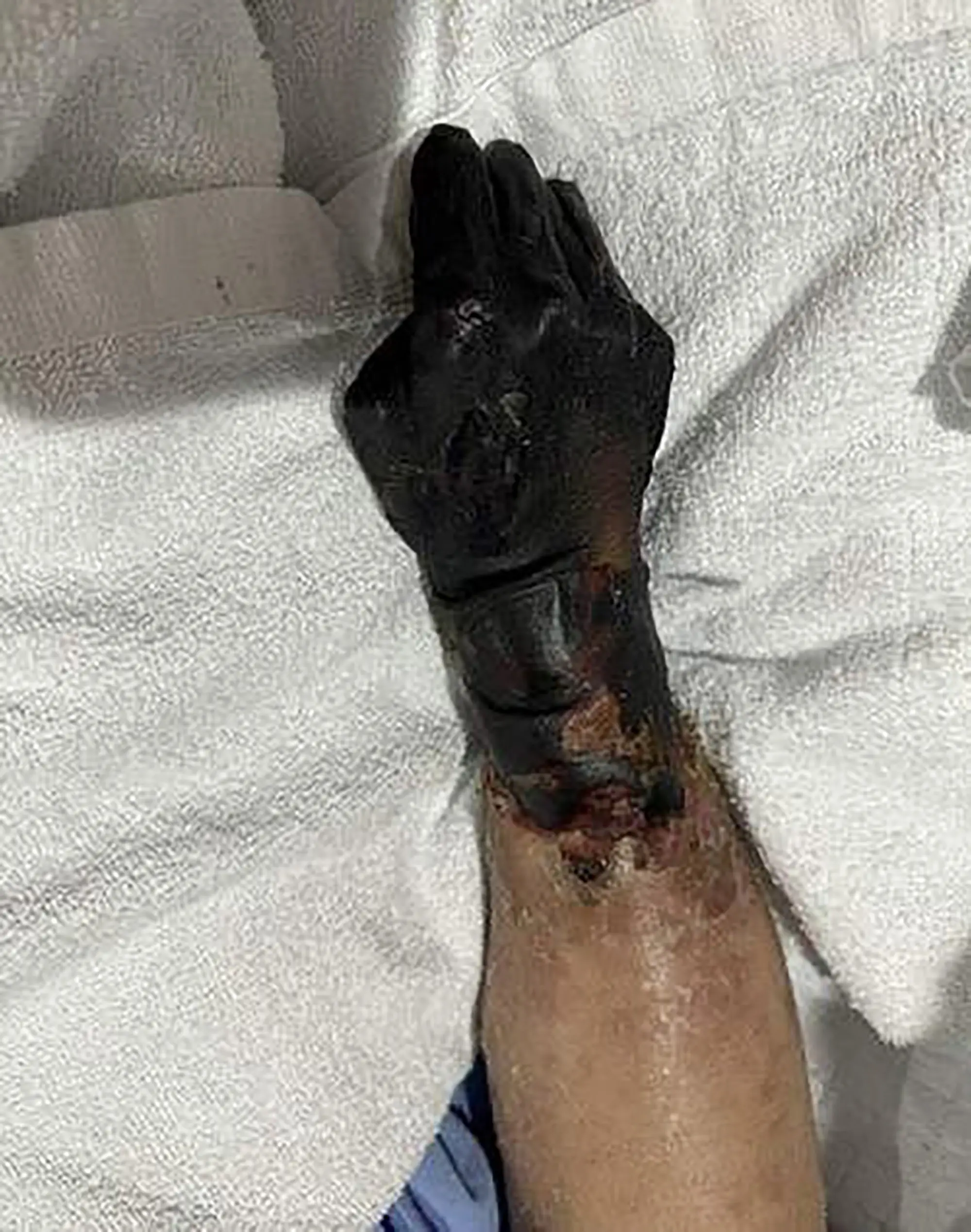 Ling's hands and feet turned black. (Newsflash)