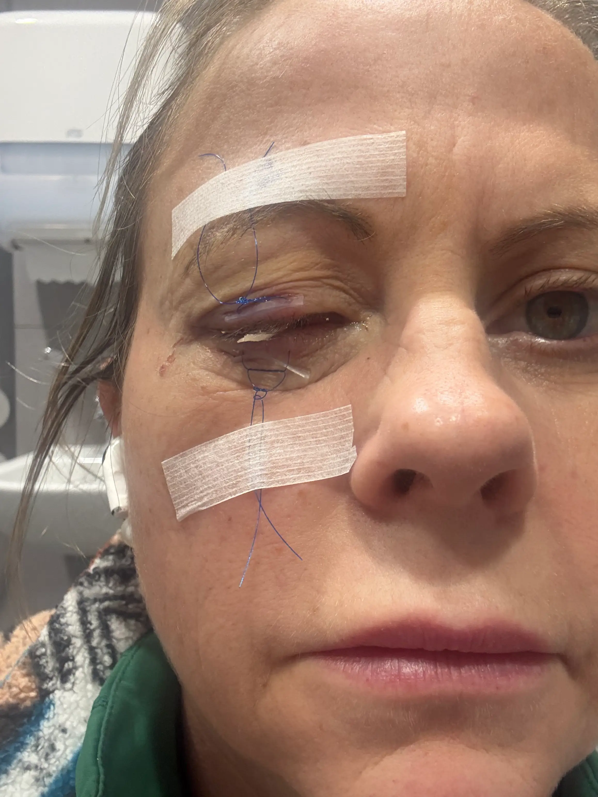Emma had to have her eye sewn shut and will need a cornea transplant, which could be a long wait (Kennedy News and Media)