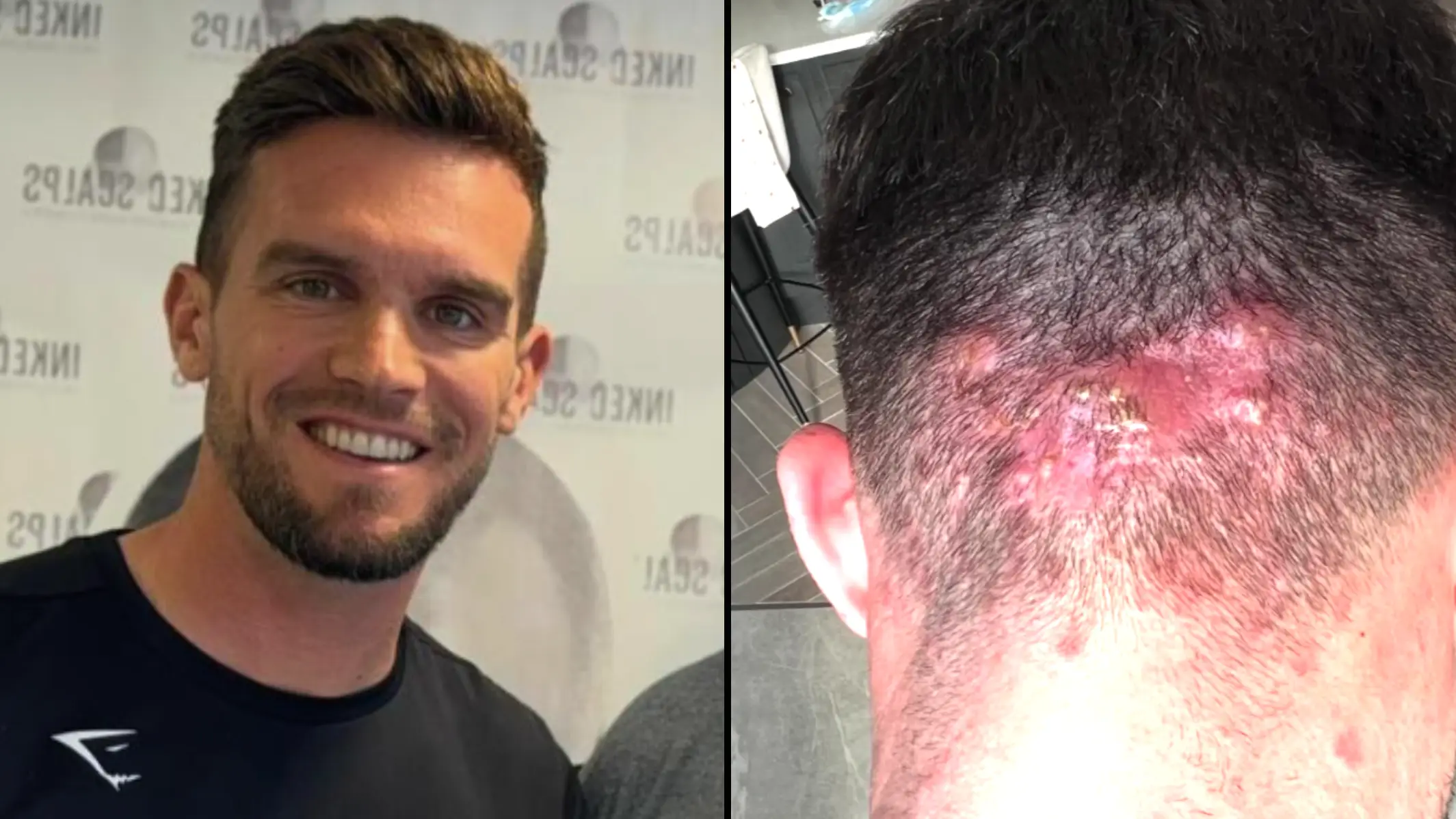 Gaz from Geordie Shore shares shocking photos of skin condition that developed after haircut