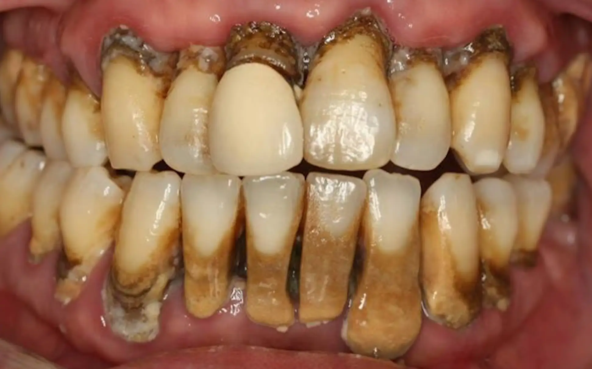 Damage to the gums could cause them to recede and expose the teeth to further damage (YouTube/Katranji & Nemeth DDS)