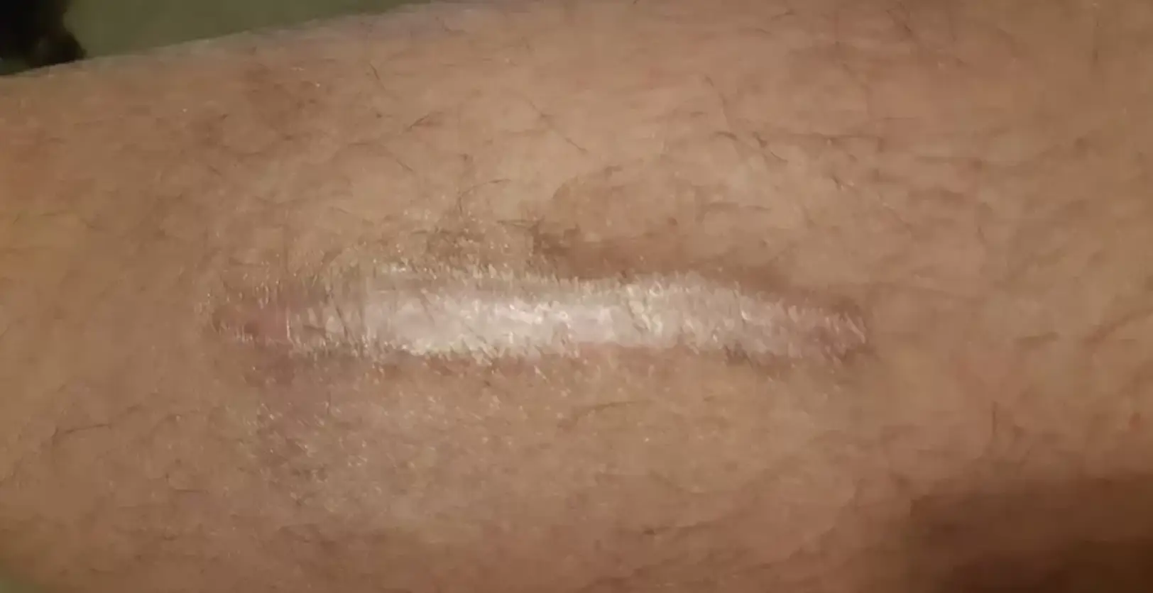 Neil has been left with a nasty scar.