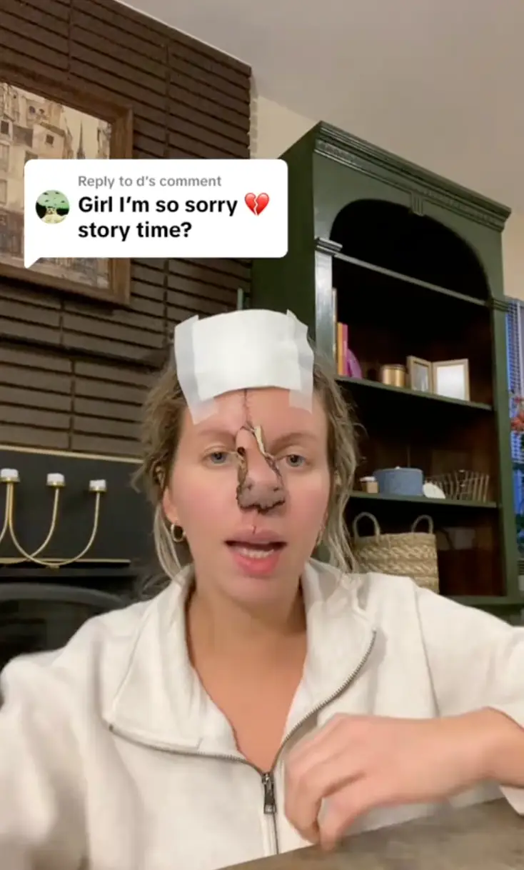 Shayna is now missing most of her nose and needs forehead flap surgeries to reconstruct her face (TikTok/@shaynabcrimo)