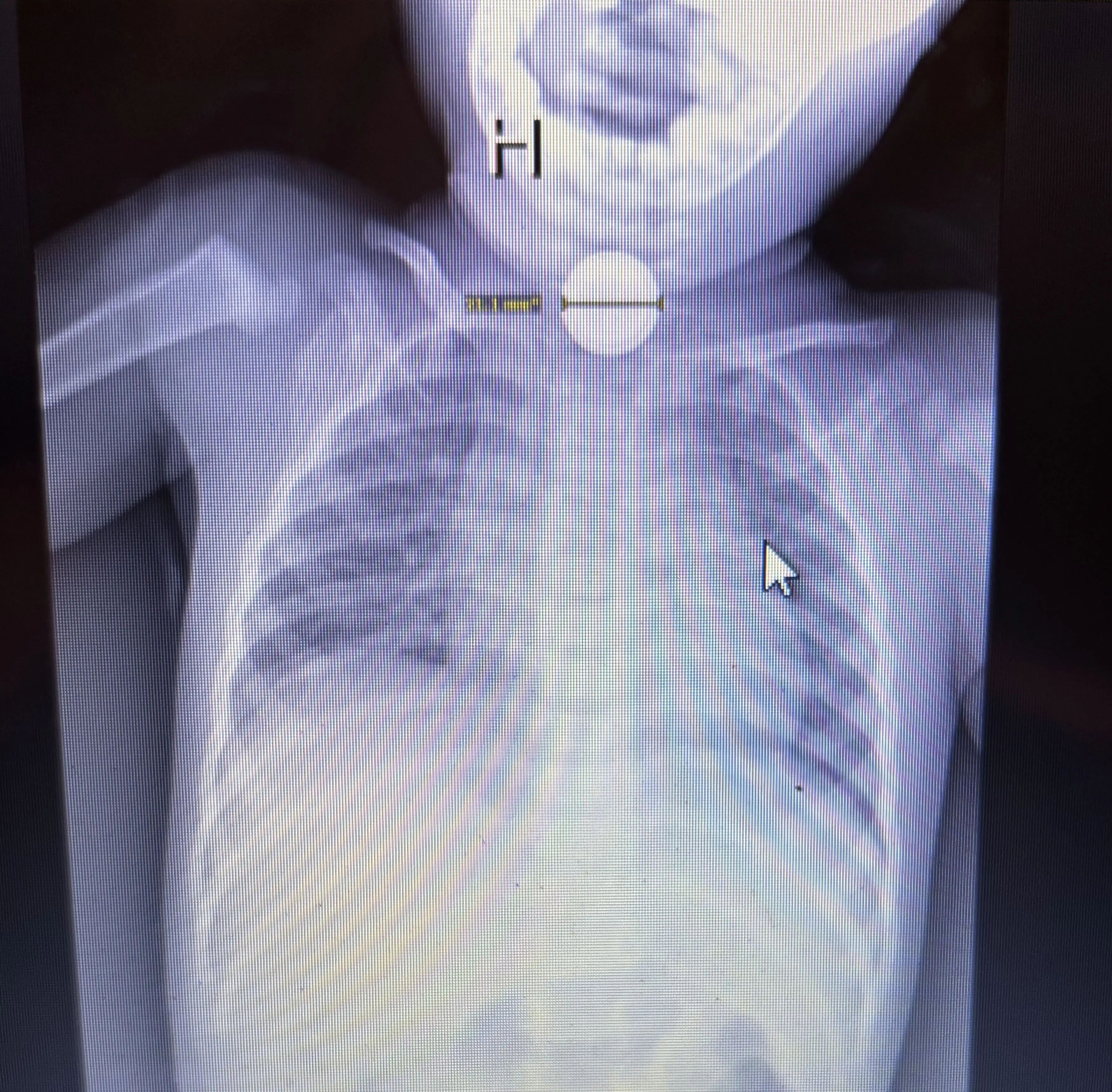 An X-ray discovered the button battery (Kennedy News and Media)