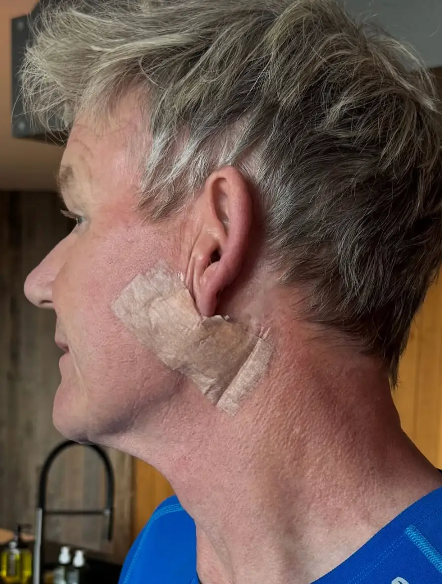 He shared a snap of his stitched-up ear with fans (Instagram/@gordongram)