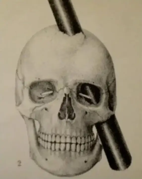 Gage's injury became a huge neuroscience discovery.