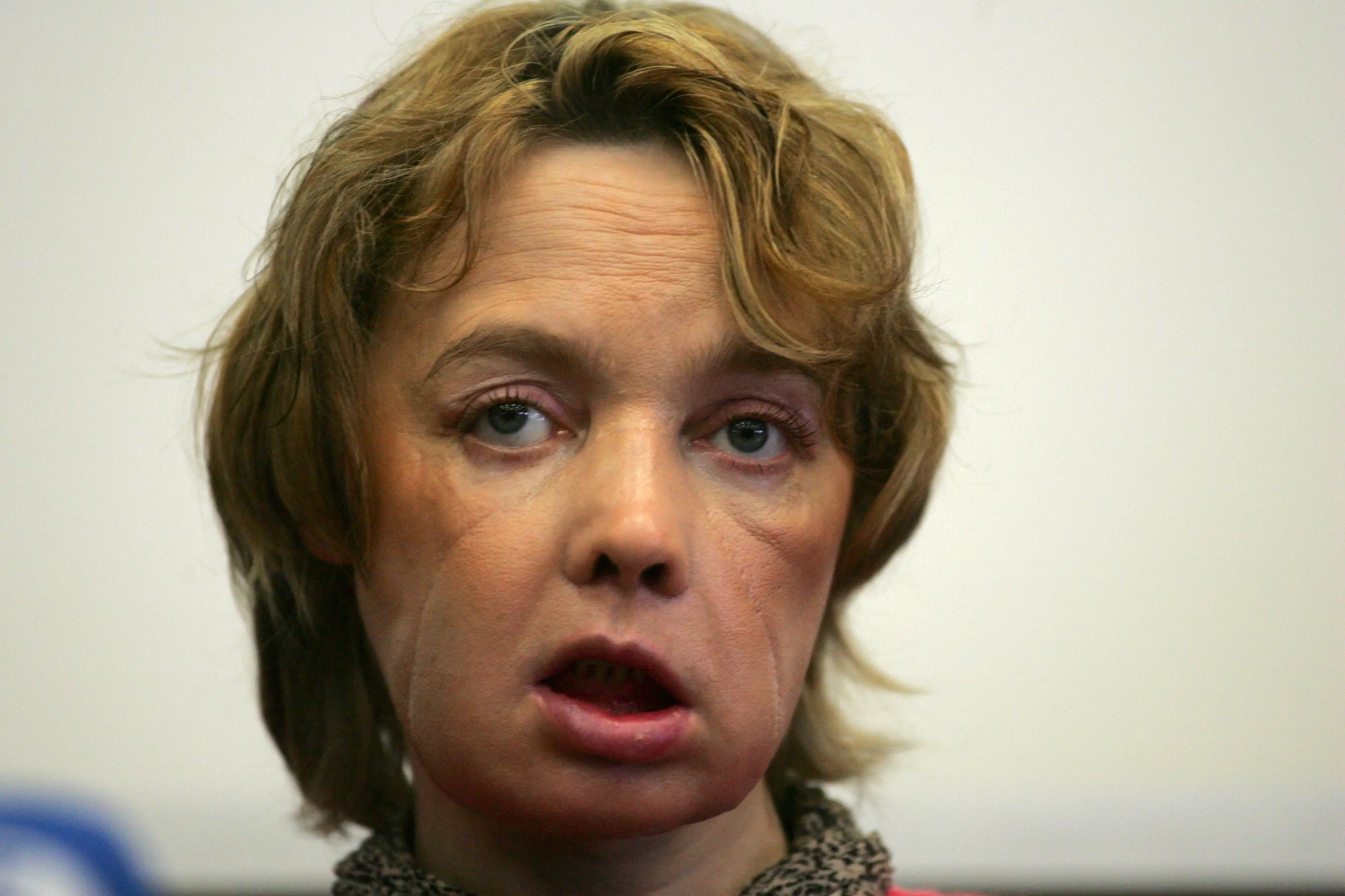 While her surgery was initially deemed successful, Isabelle suffered devastating consequences afterwards.