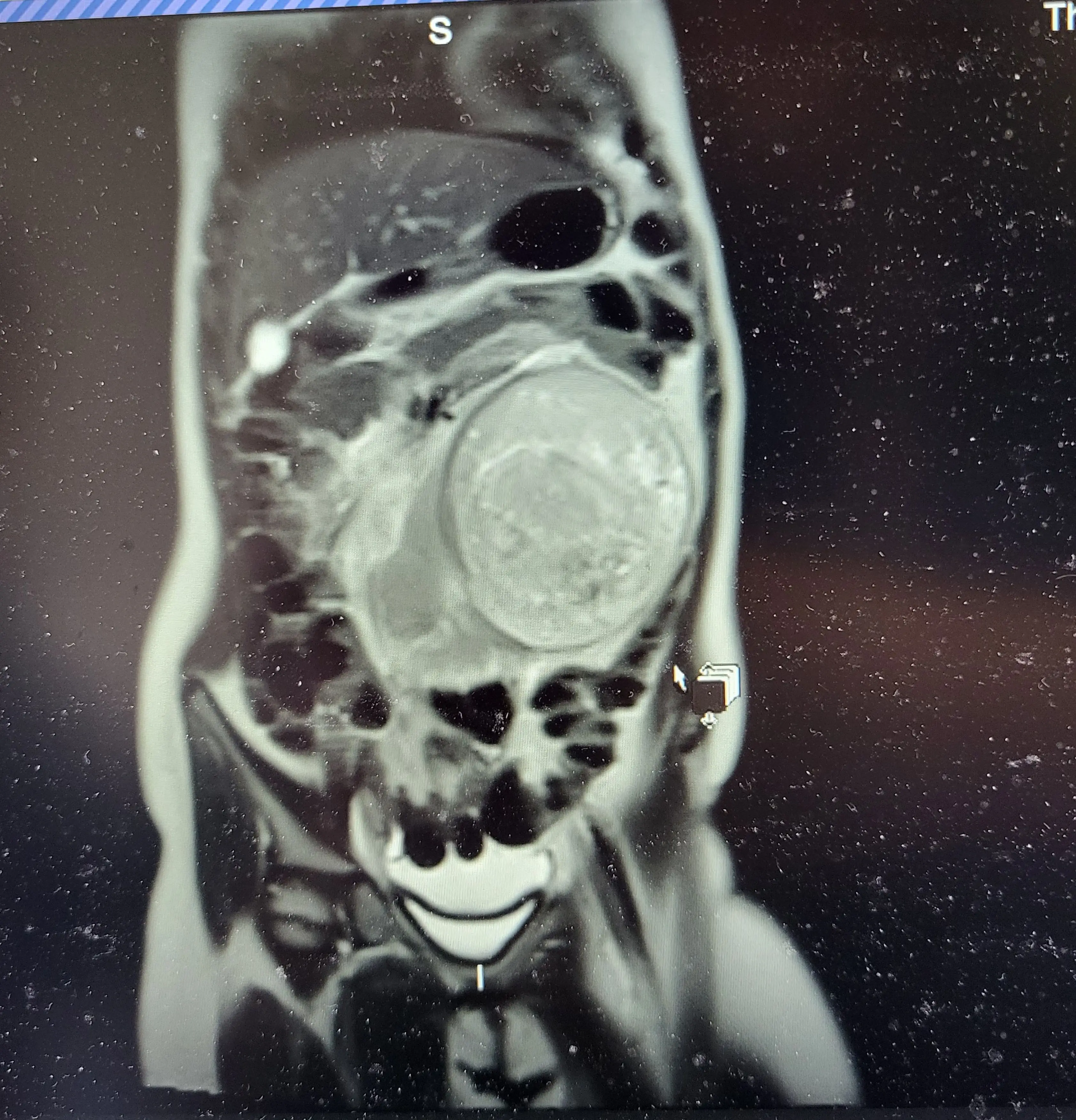 Mia was diagnosed with stage two kidney cancer and a Wilms' tumour (Kennedy News and Media)