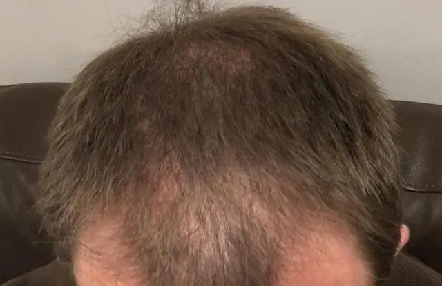 Before using the Regaine Hair Treatment (Image credit: JCS / Amazon Reviews)