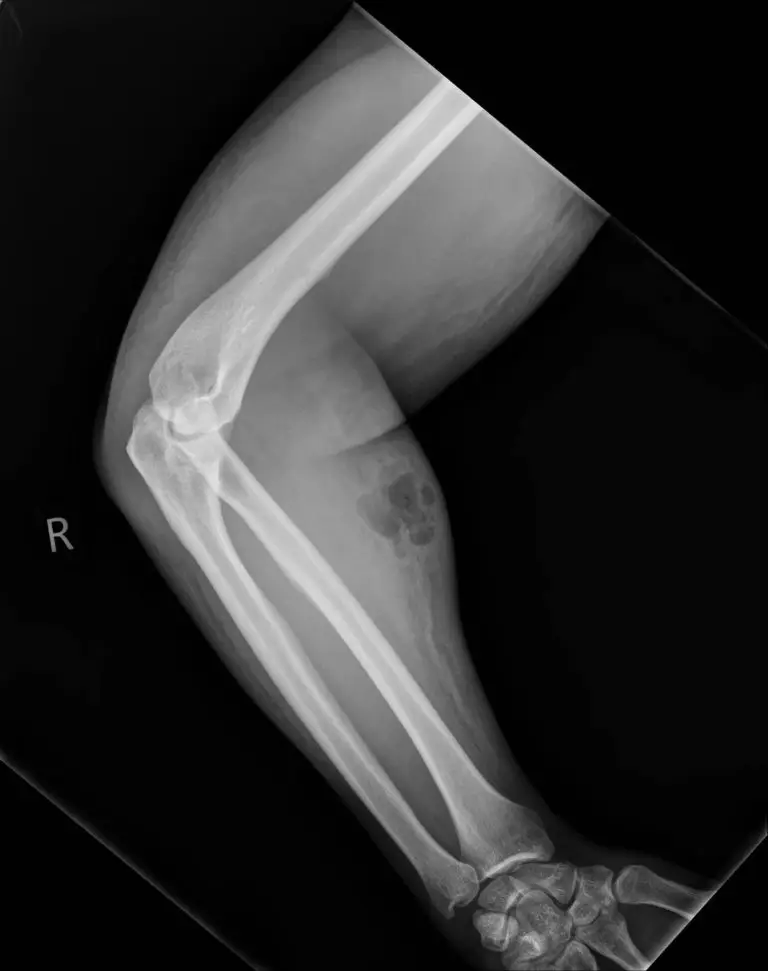 An X-ray showing the swelling at the location where sperm had been injected (IMJ)