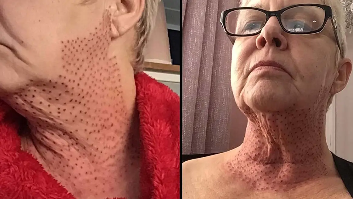 Horrified woman left ‘looking like a lizard’ after botched procedure
