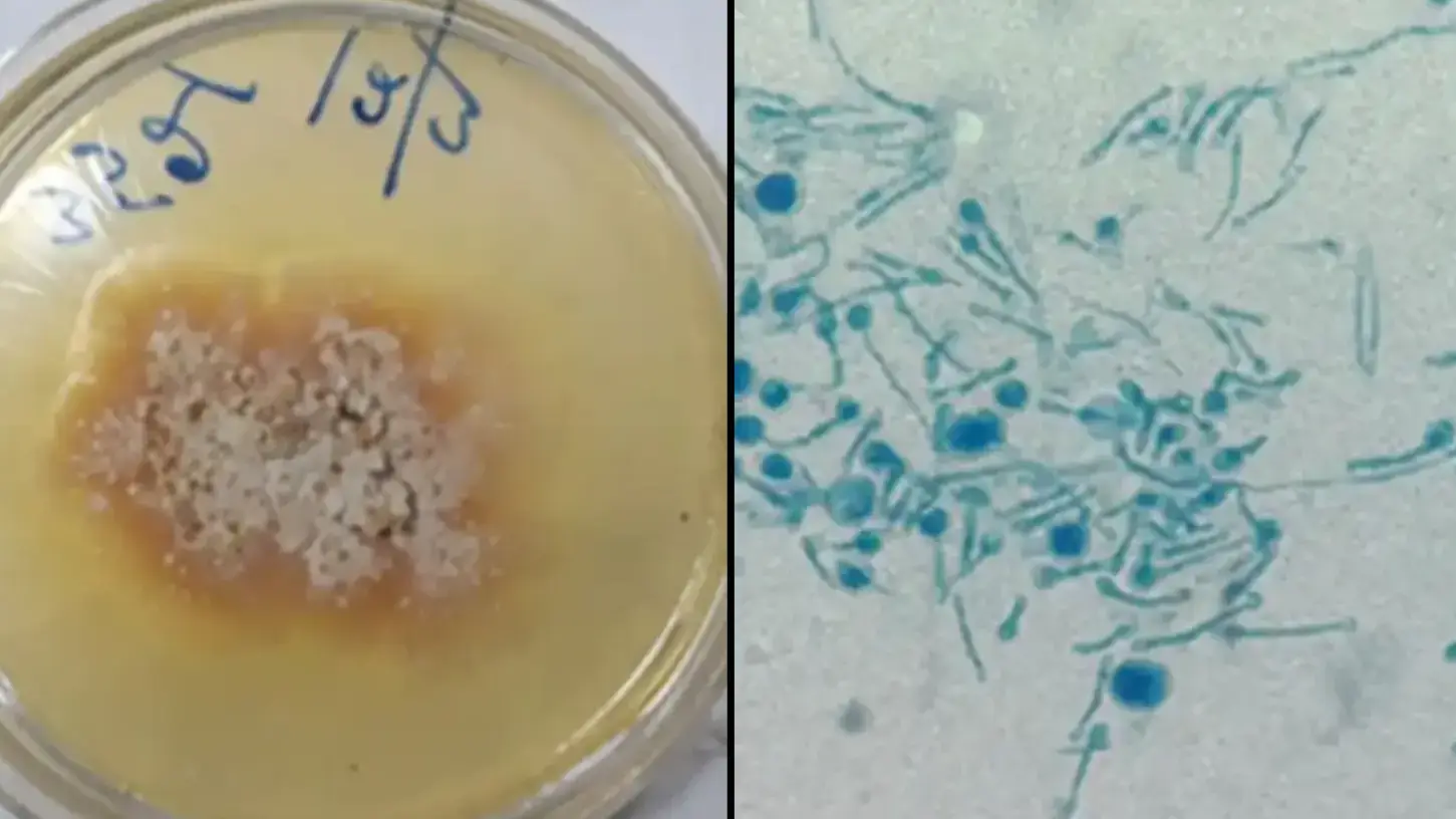 Man becomes first known person to be infected by killer plant fungus