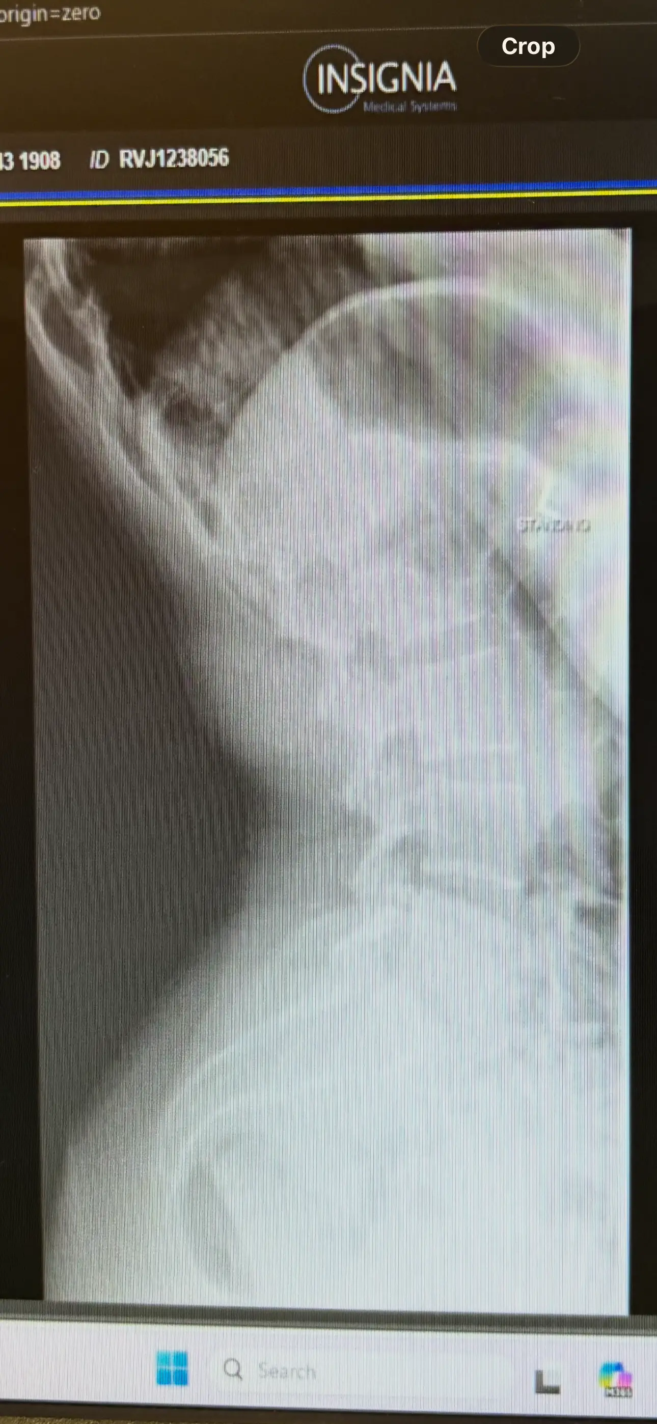 She suffers from chronic back pain as a result of kyphosis (Charlotte Innes/GoFundMe)