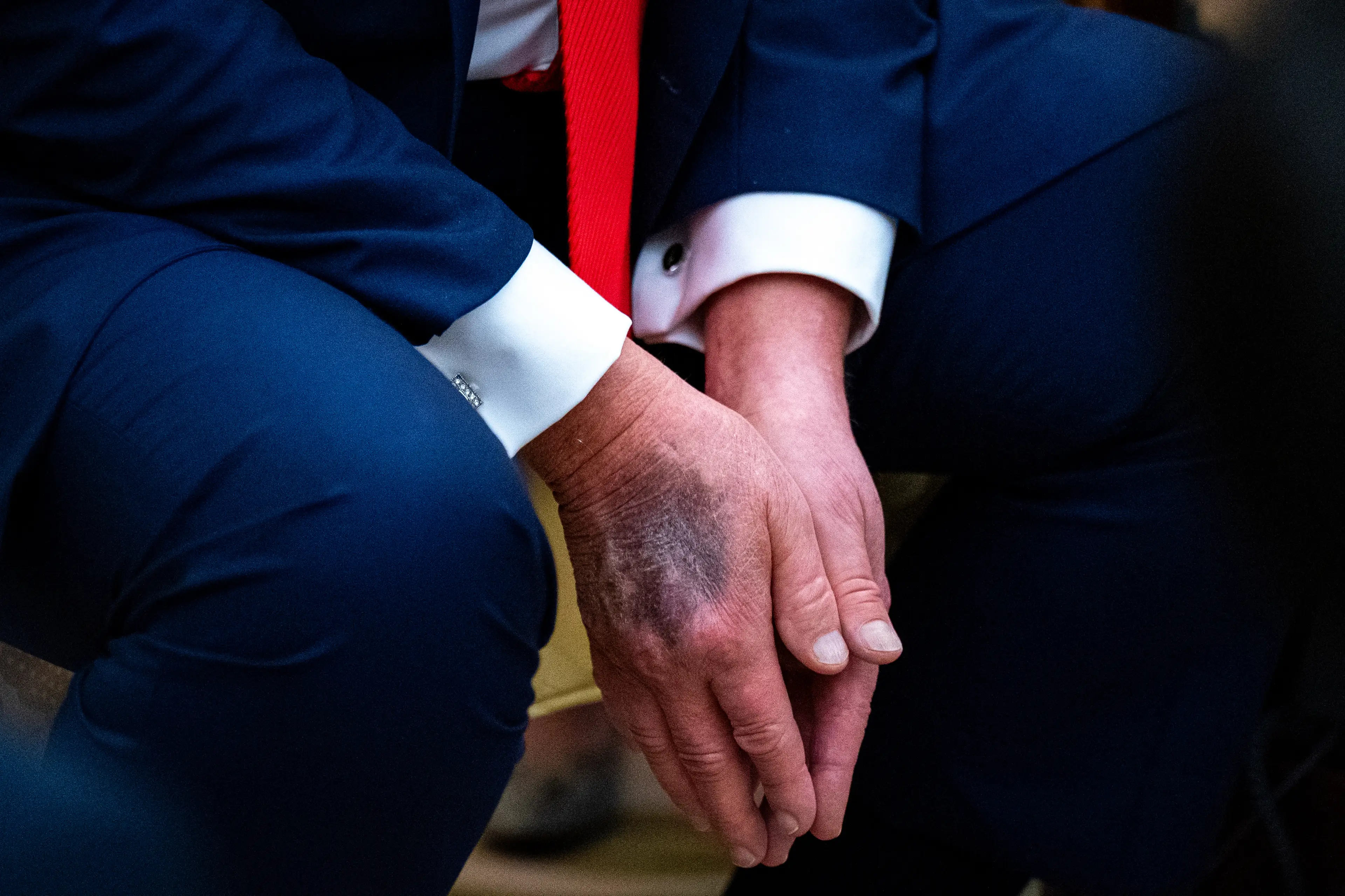 Bruises on his hands led some to believe Trump was in very poor health (Al Drago/Bloomberg via Getty Images)