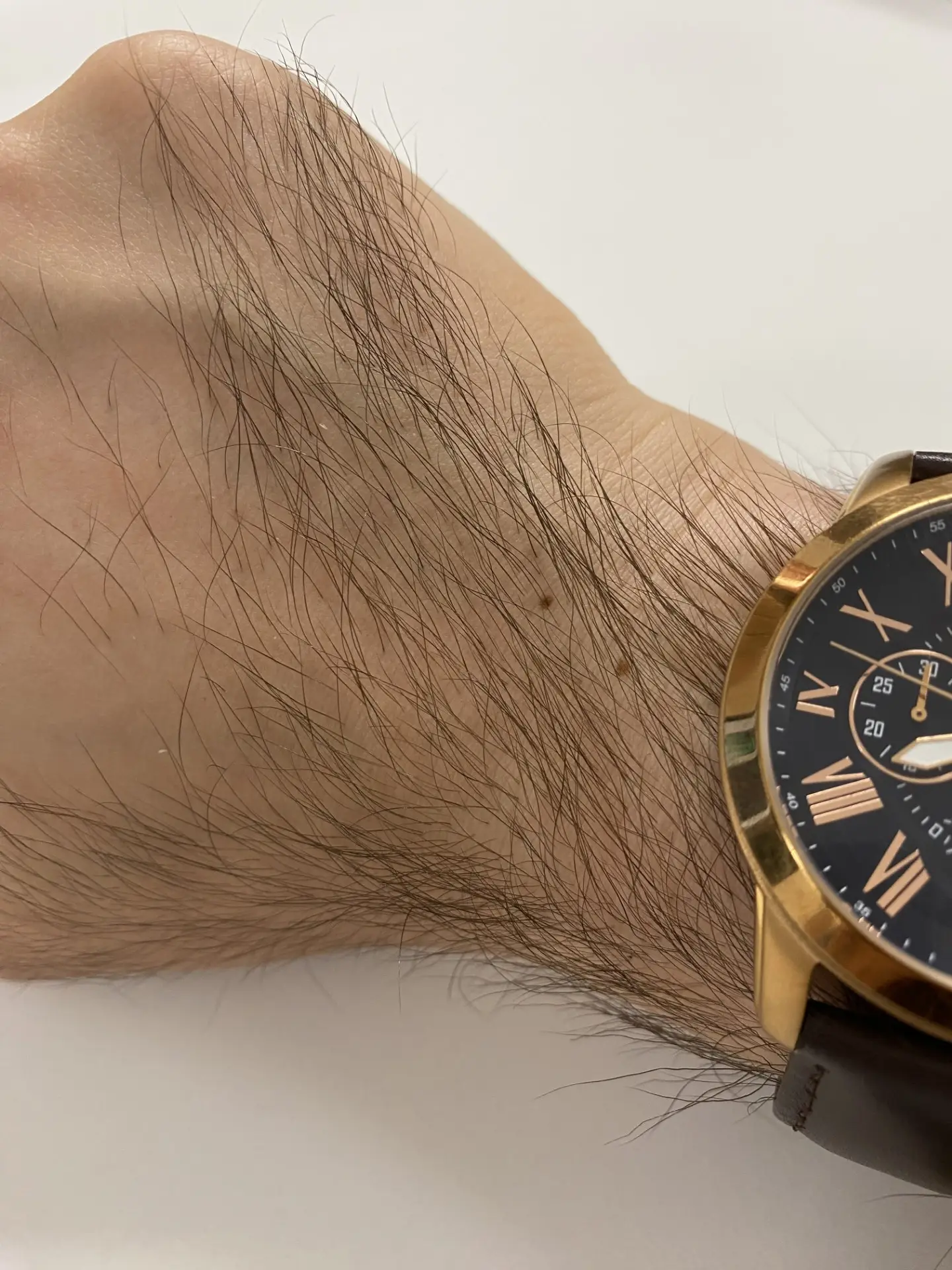 I have a spare hand/wrist freckle if anybody is feeling left out (Supplied)