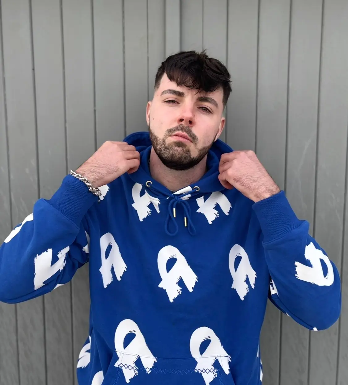 Ruben first noticed bald patches in his eyebrows as a teenager (Supplied)