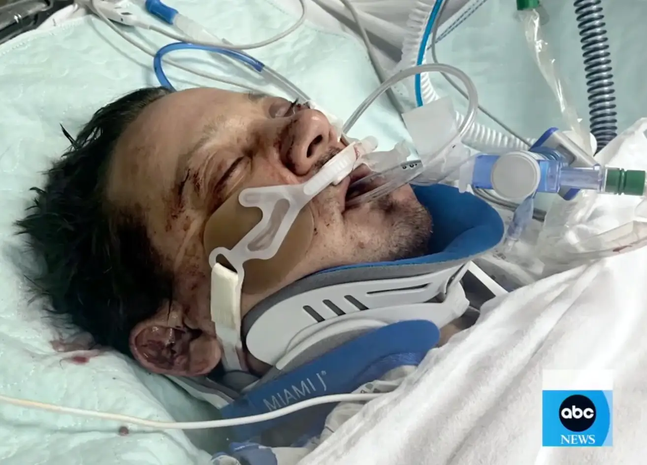 Renner recalled how his left eyeball 'violently burst out of his skull' after the orbital bone surrounding his eye socket was broken (ABC News)