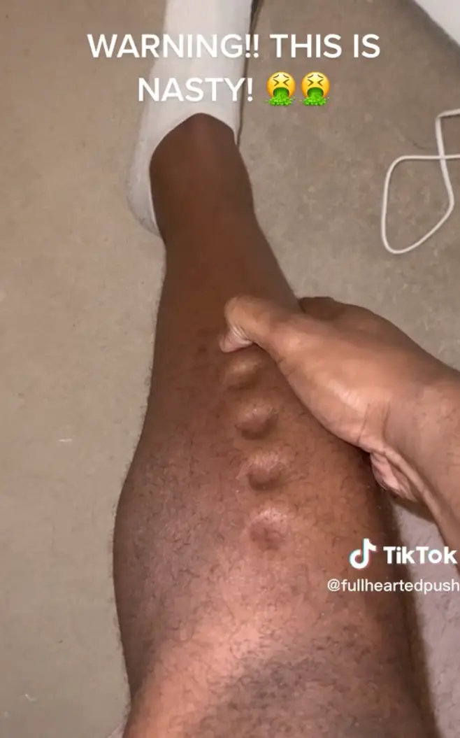 Lawrence was able to knead his leg like playdough.