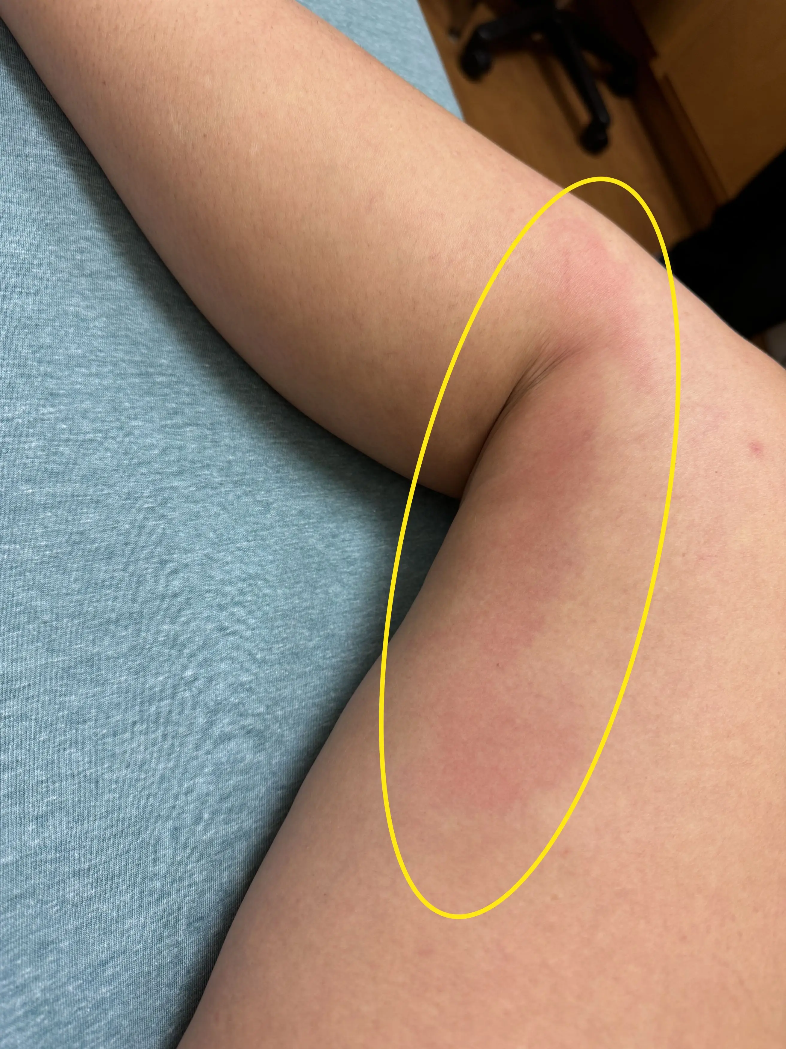 The red mark spread up her leg (Kennedy)