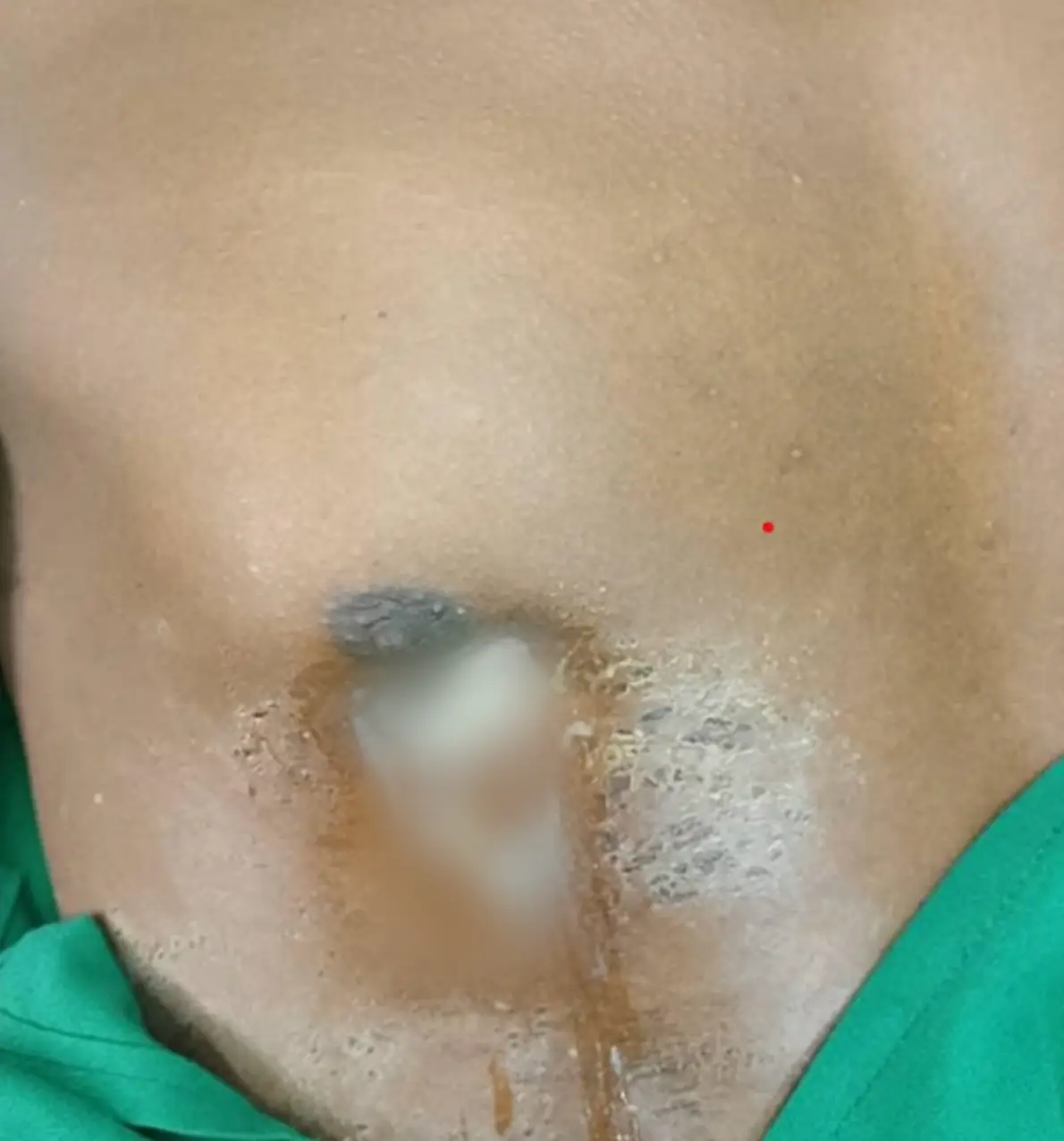 It wasn't a small amount of pus (National Library of Medicine)