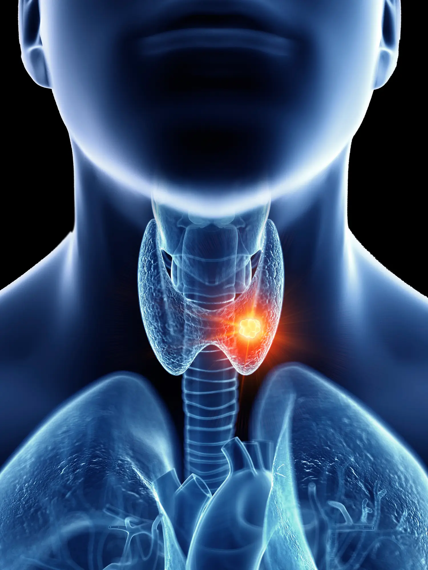 Head and neck cancer accounts for three percent of all new cancer cases in the UK (Getty Stock Images)