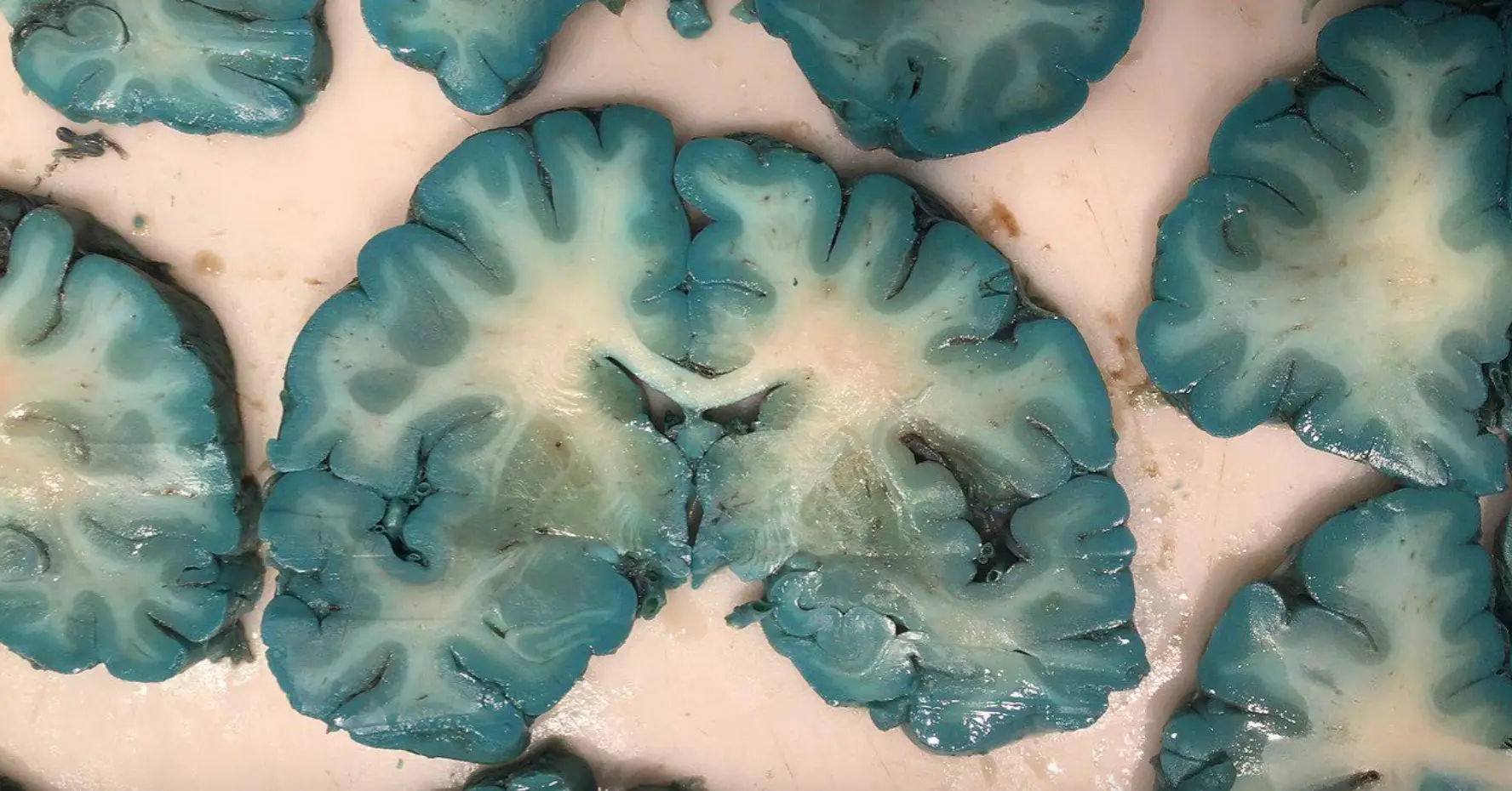 The brain turned blue after the patient was treated using methylene blue (Wikimedia Commons)