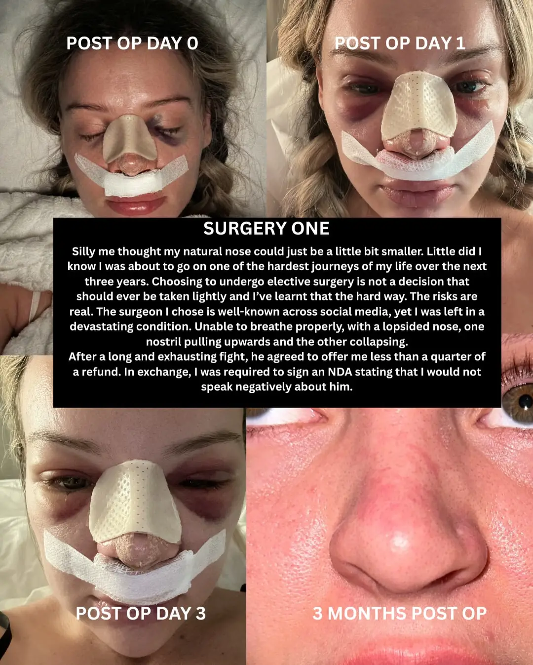 Love Island Australia star Kim Hartnett said her first nose job cause big problems (Instagram/@kimhartnett_)