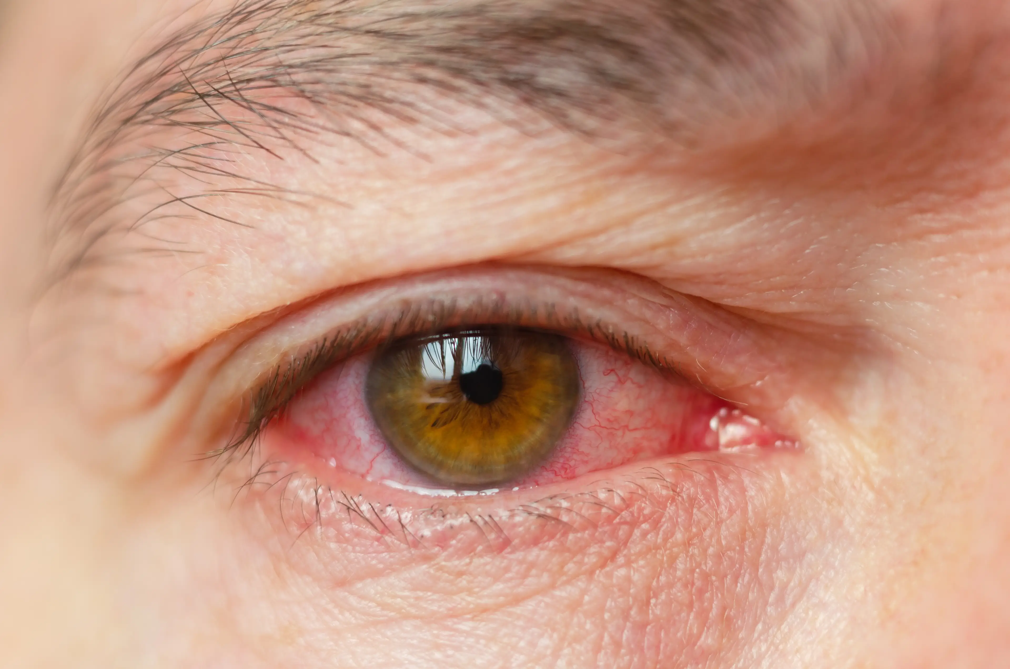 Eye infections are common, but can be serious (Getty Stock Images)