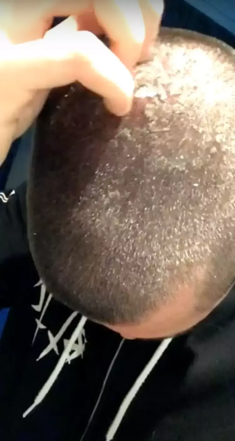 Aidan says he experienced scalp issues in the past (YouTube/Garden of Aidan)