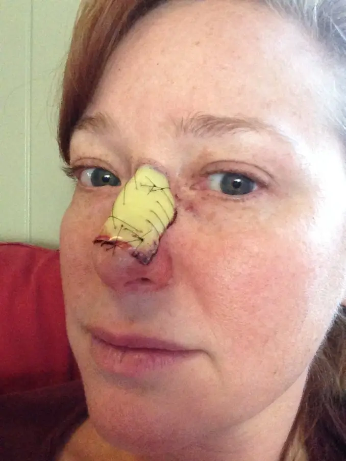 About 20 years after a doctor recommended she try sunbeds Liz was diagnosed with skin cancer, she's had skin cancer on her leg twice and her nose once (SWNS)