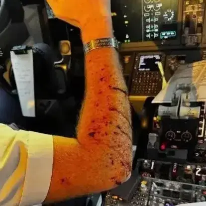 How the pilot's arm allegedly looked (X)