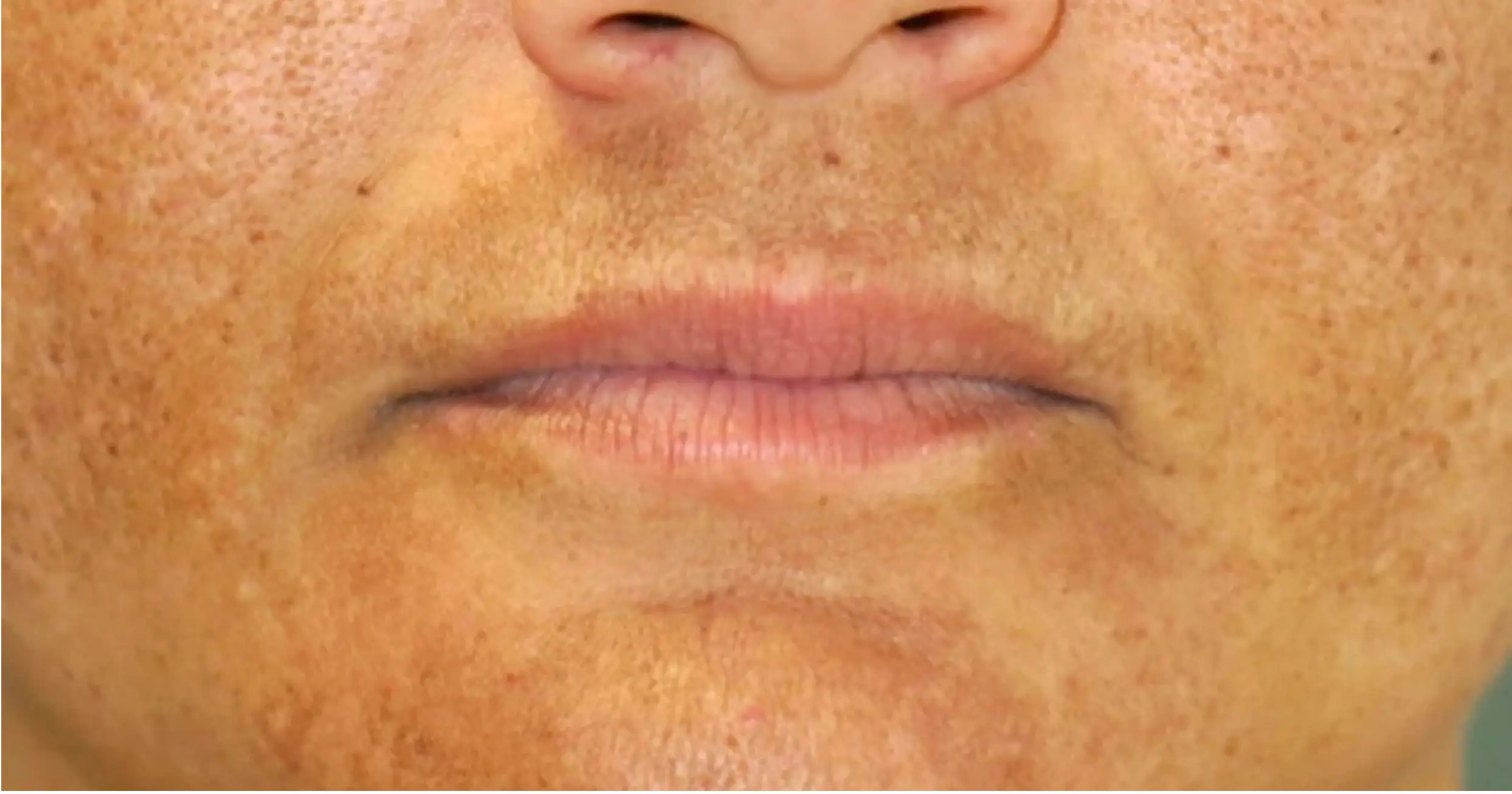 Melasma most commonly impacts women (British Skin Foundation)