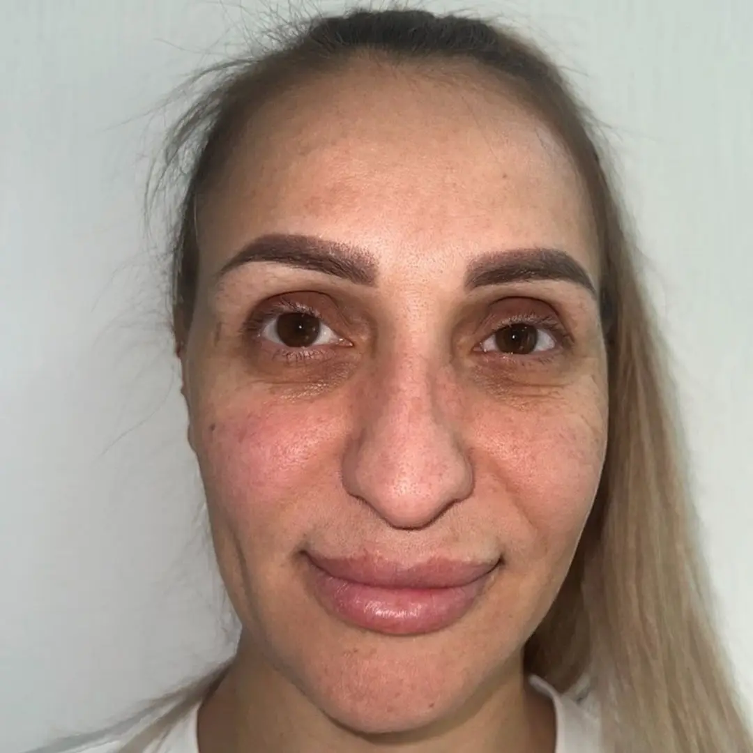 Katherine before... (Instagram/@esteistanbultr)