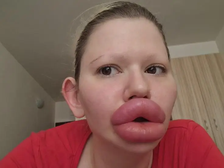 Andrea after spending over $26,000 on lip filler (JamPress)