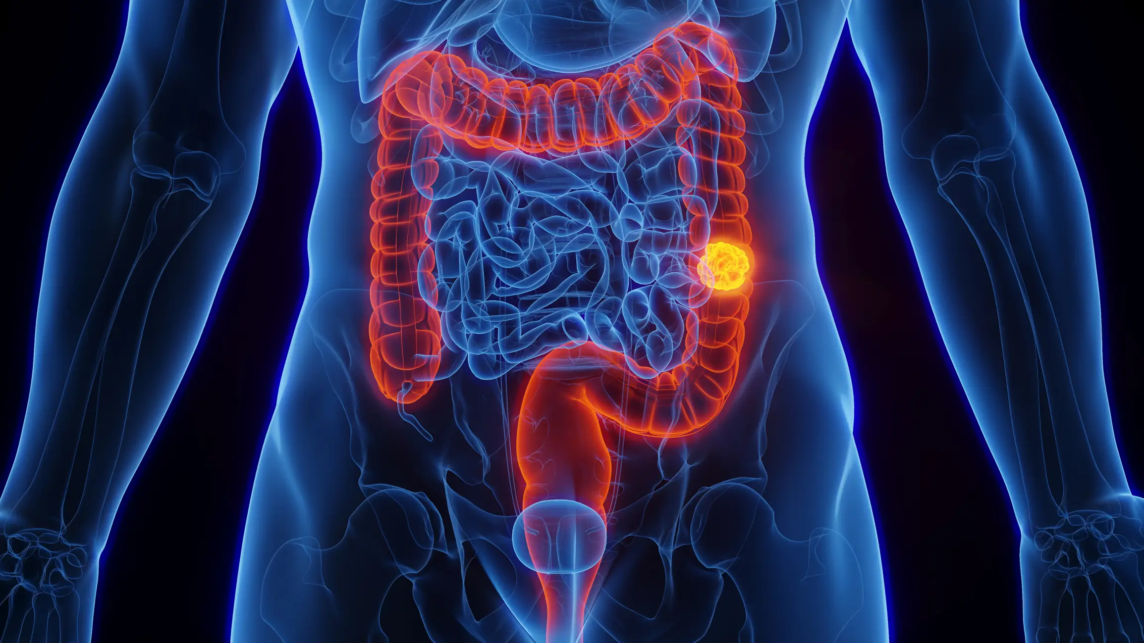 Colon cancer is the third most common cancer (Getty Stock Images)