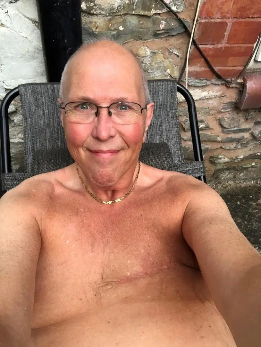 Jim had to undergo a mastectomy.