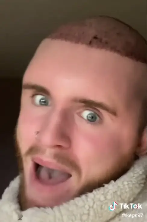 Kegs has come a long way since getting his hair transplant.