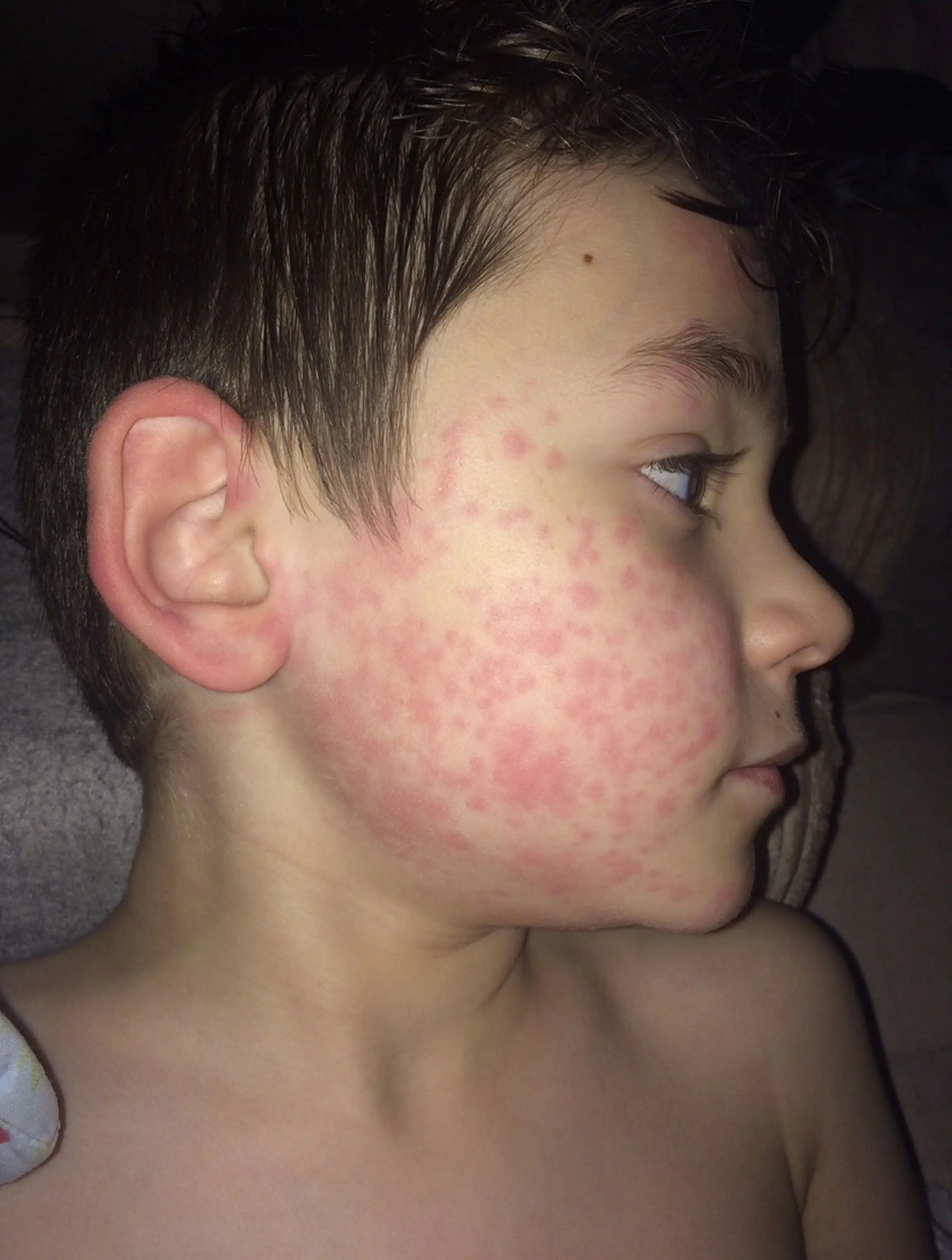 Calum breaks out in hives if he gets cold.